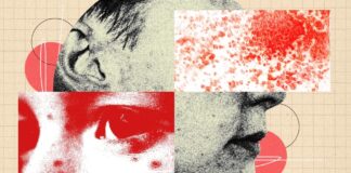 Die verborgene Schwere der Gürtelrose: Warum „Höllenfeuer“ mehr als nur ein Ausschlag ist