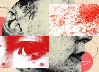 Прихований тягар лишаю, що оперізує: чому «пекельний вогонь» — це не просто висип